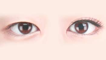 Oriental Eyelid Surgery 1