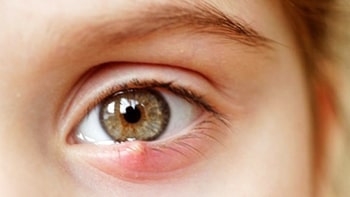 eye care chalazion treatment
